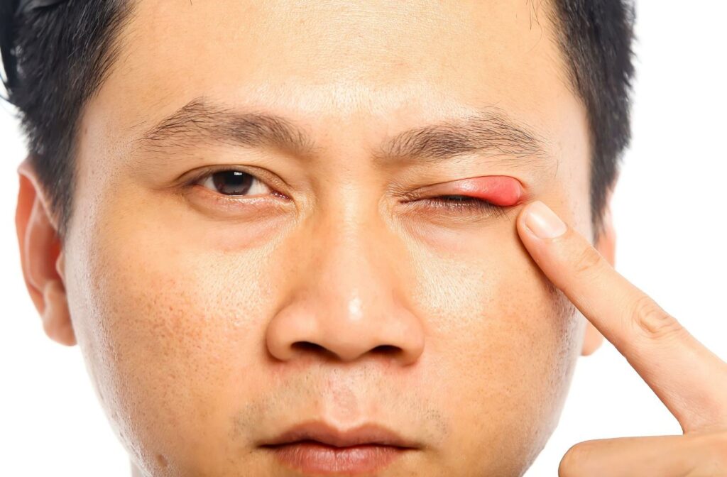 Close-up of a person with a swollen red bump on their upper eyelid, showing what a stye can look like.