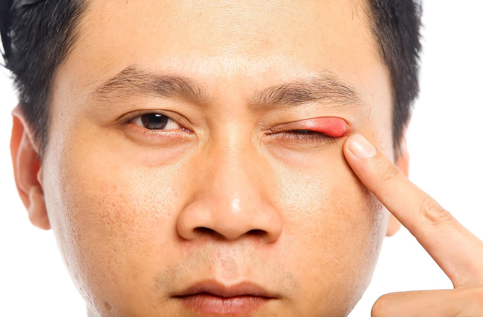Close-up of a person with a swollen red bump on their upper eyelid, showing what a stye can look like.